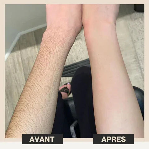 LumiSmooth™ – Épilation à la lumière pulsée