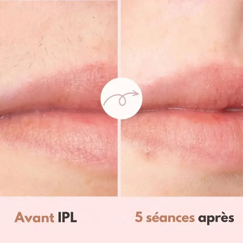 LumiSmooth™ – Épilation à la lumière pulsée