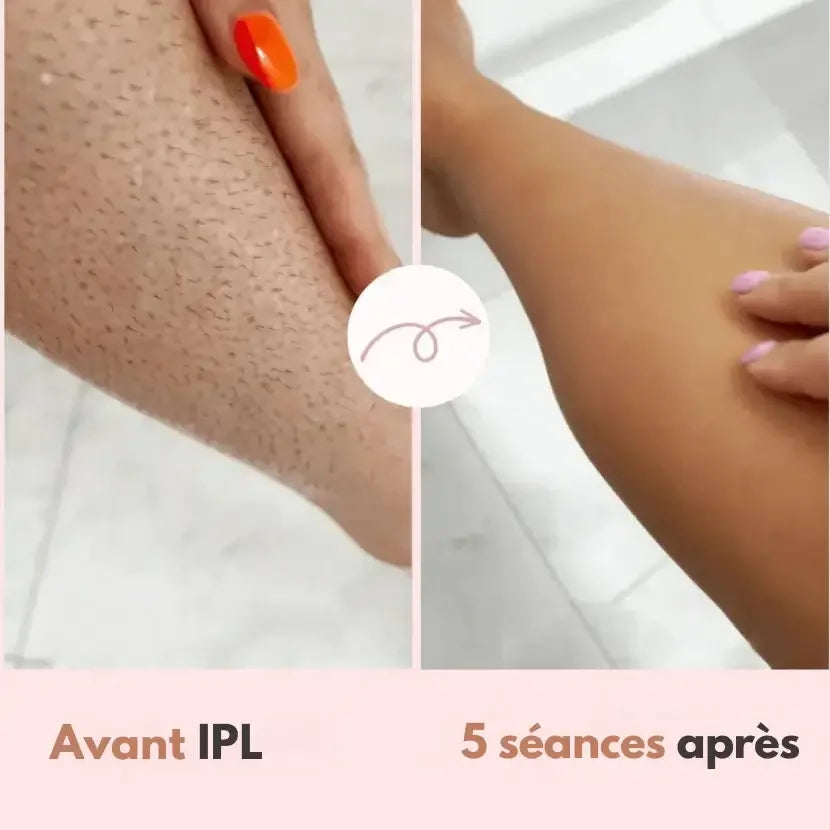 LumiSmooth™ – Épilation à la lumière pulsée