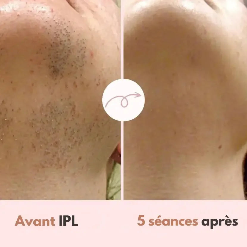 LumiSmooth™ – Épilation à la lumière pulsée