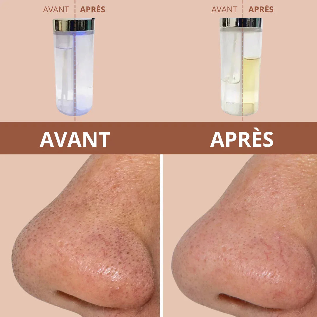 Bubble clean, Extracteur de points noirs avec eau.