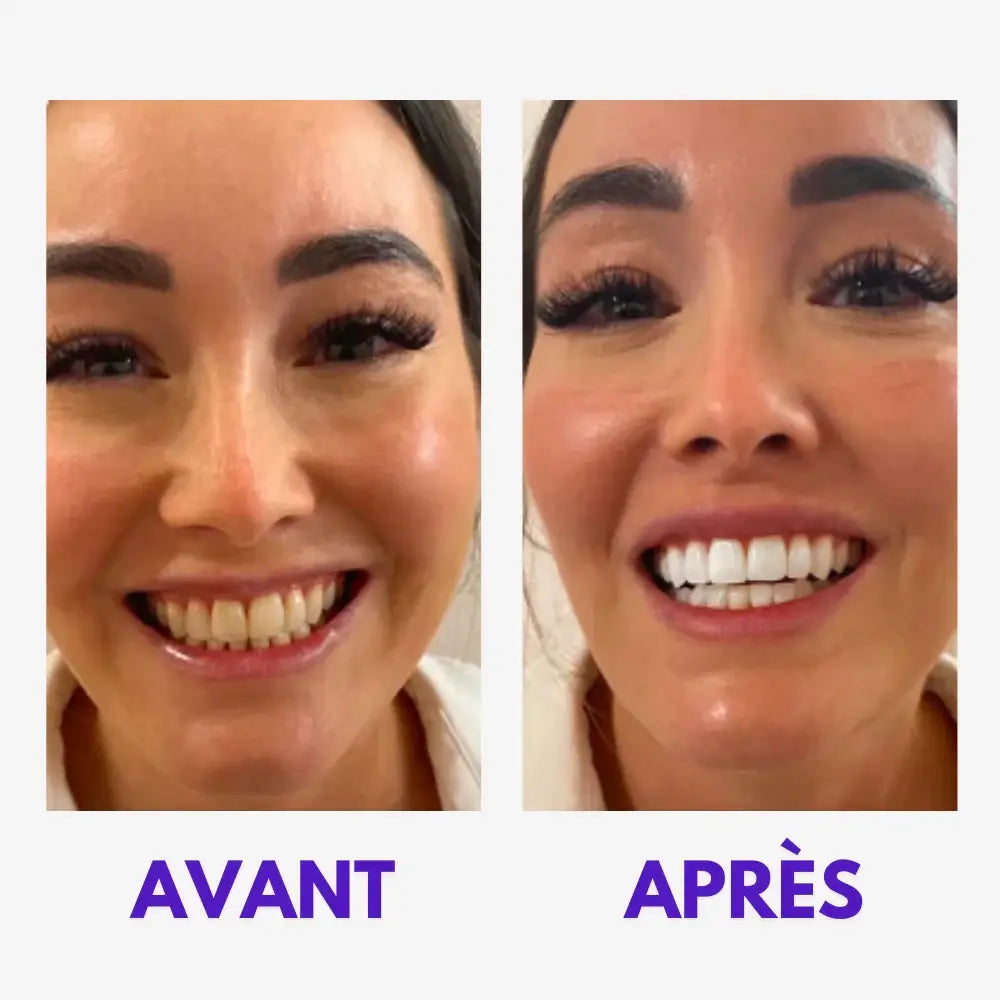 Smile kit™V34 Blanchiment Instantané Sans Peroxyde