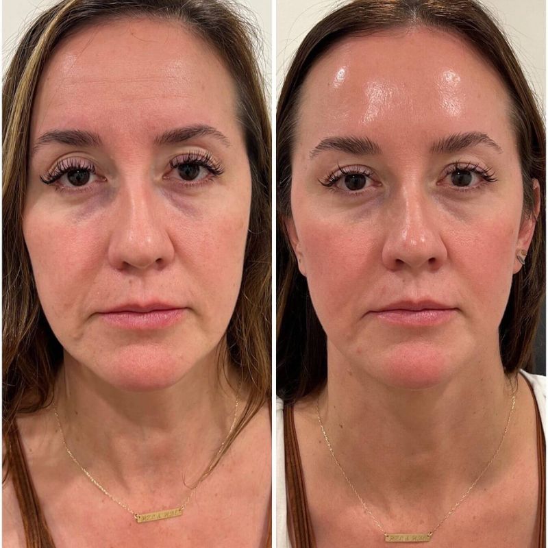 Retinal Shot™ – Rides d’Expression Lissées