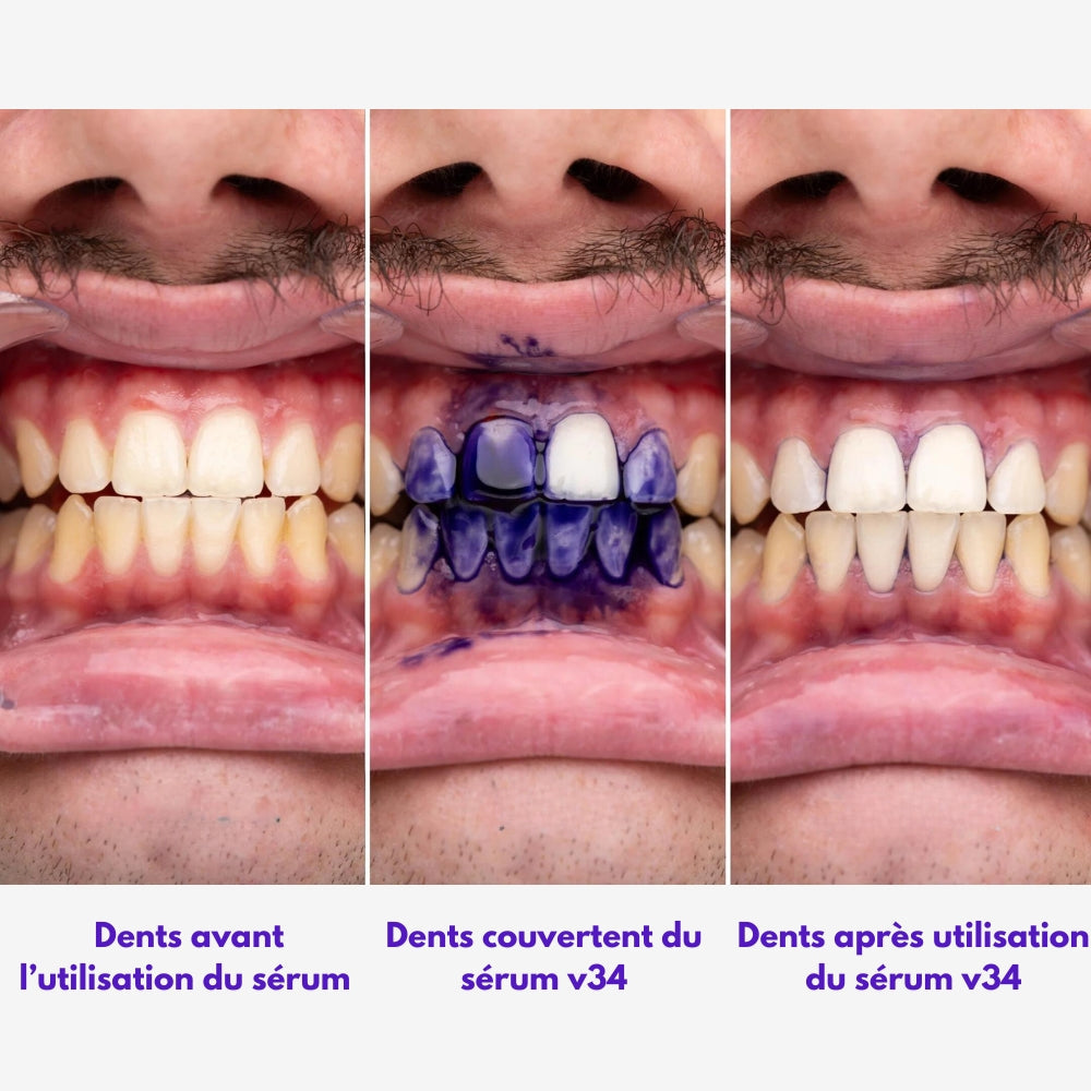 Smile kit™V34 Blanchiment Instantané Sans Peroxyde