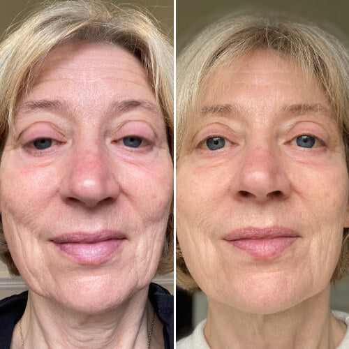 Retinal Shot™ – Rides d’Expression Lissées